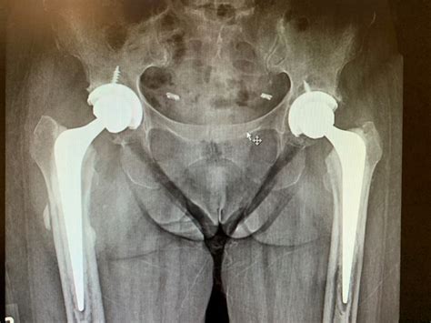 Case Study: Bilateral Hip Replacement in 66 Year Old Female