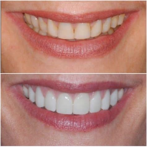 Veneers Before and After Results