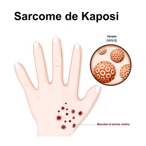 Kaposi's sarcoma: symptoms, evolution, transmission - Archyde