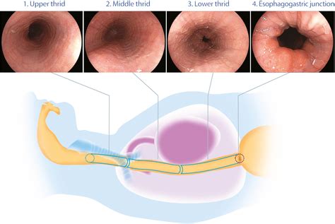 Principles and practice to facilitate complete photodocumentation of the upper gastrointestinal ...