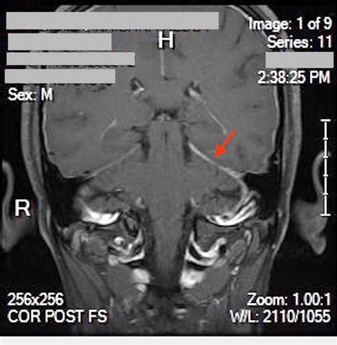 MRI brain without contrast, showing asymmetric tentorial enhancement... | Download Scientific ...