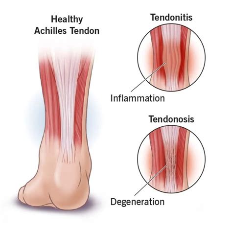 Achilles Tendonitis