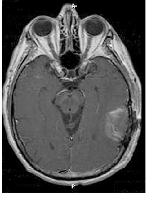 Neuroimaging of a gliosarcoma before surgery. Gadoliniumenhanced ...