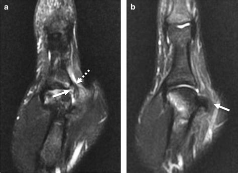 Stener lesion. 16-year-old boy with acute thumb injury 2 weeks ago ...