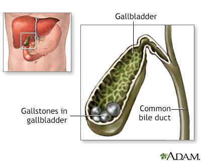 Gallstones - Symptoms and Causes