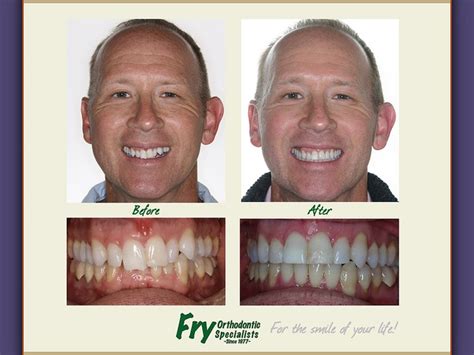 Fry Ortho Before and After | Dental retainer, Orthodontics, Dental