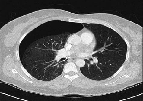 Chest CT revealed right-sided pneumothorax without any parenchymal... | Download Scientific Diagram