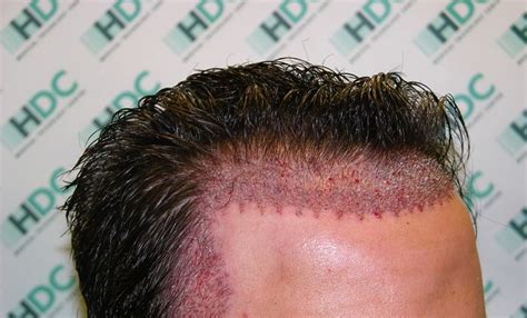 Top 5 Clinics in the US for Hair Transplant Procedures