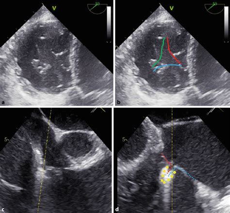 a-c Visualisation of tricuspid valve clipping by transoesophageal ...