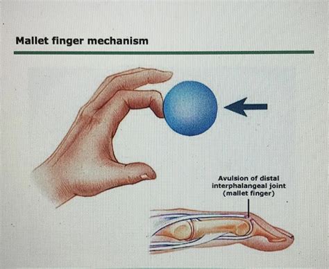 Distal Interphalangeal Joint