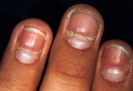 Nail bed abnormalities - Awesome Nail