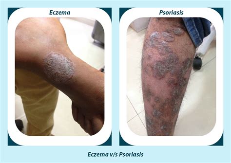 Eczema and Psoriasis at the same time? Consult now with Tibot | Tibot