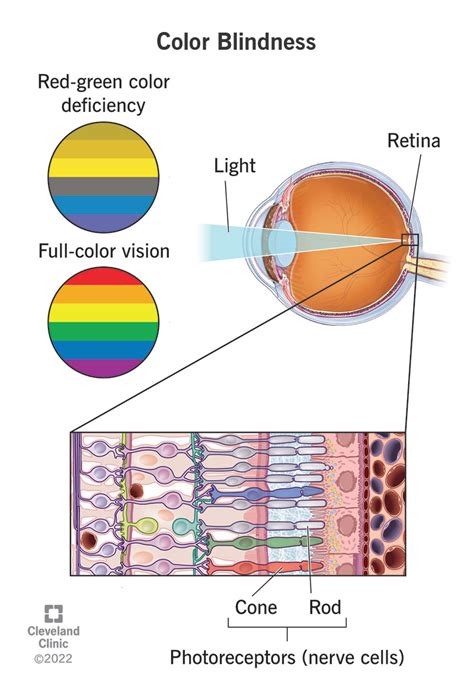 Color Blindness: Types, Causes & Treatment | Flipboard