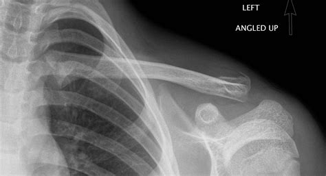 Fractures - Clavicle