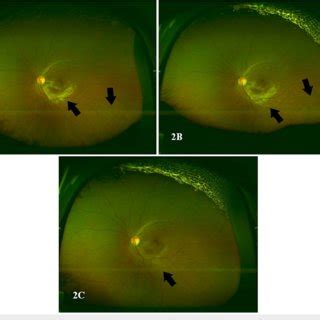 Optos color fundus photo of the left eye (A) Optos color fundus photo ...