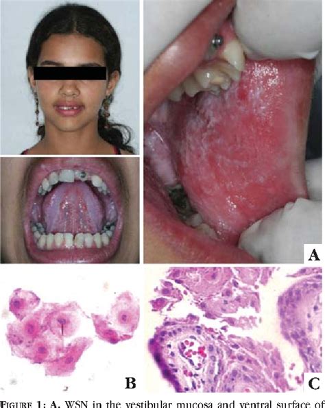 Figure 1 from Familial case of oral white sponge nevus--a rare hereditary condition. | Semantic ...