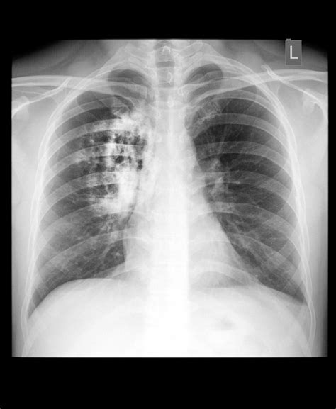 Lung Cancer Symptoms Causes Diagnosis Treatment How T - vrogue.co