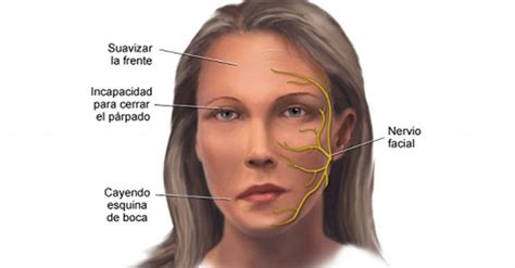 Parálisis Facial: Cómo Prevenirla Y Tratarla | Delicias Blog