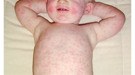 17 Most Common Types Of Baby Rashes (With Pictures), 56% OFF