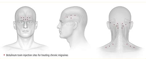 Botox injections for Migraine (Botulinum toxin) – Bridgemill Neurological Associates