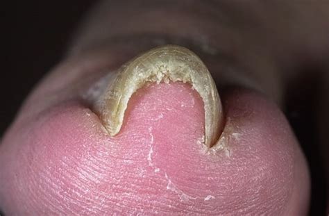 Pincer Nail - Causes, Characteristics and Possible Treatments | Nail fungus, Treatment, Nail ...