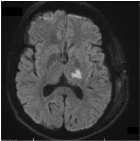 Axial diffusion-weighted MRI shows restricted diffusion in the ...