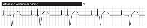 Interpretation of Pacemaker ECG – Cardiovascular Education