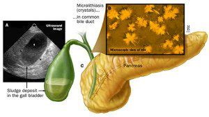 Biliary Microlithiasis Causes Up To 79% Of Idiopathic Acute Pancreatitis - Beating Pancreatitis