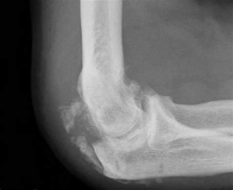 Myositis Ossificans: Causes, Symptoms & Treatment