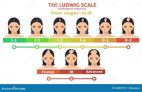 Ludwig Scale Of Androgenic Alopecia Step Poster Cartoon Vector ...