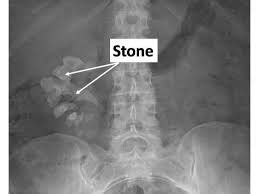 SURGSEMINAR: KIDNEY URETER stones investigations