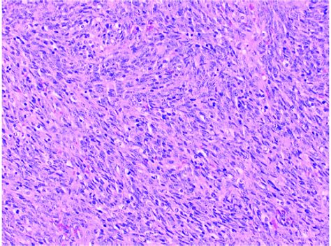 Monophasic spindle cell synovial sarcoma composed mainly of uniform... | Download Scientific Diagram