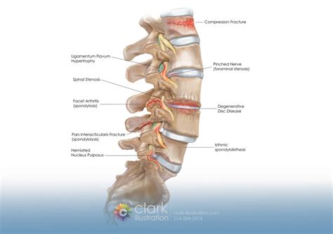 Spinal Conditions | Clark Medical Illustration