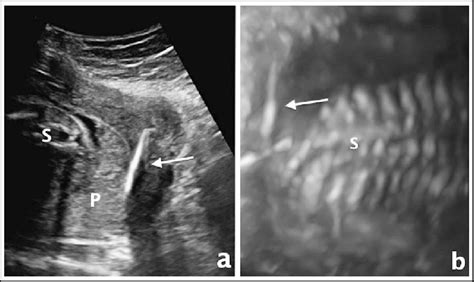 a) The embedded IUD between placenta and myometrium was shown via Gray... | Download Scientific ...