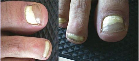 SUPERFICIAL FUNGAL INFECTIONS - Proximal subungual onychomycosis picture | Hellenic ...