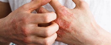 What Is Psoriatic Arthritis & How Do You Treat It? - Orthopedic ...