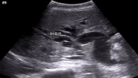 Dilated IHBR, hepatic ducts and entire CBD due to distal CBD stricture ...