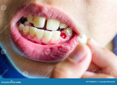 Extraction primary tooth stock image. Image of young - 97606231