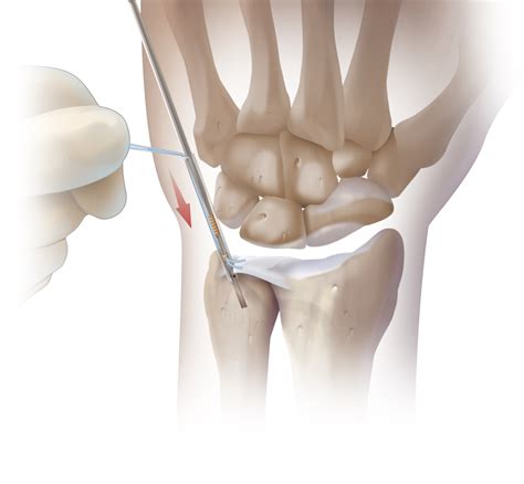 Arthrex - Arthroscopy