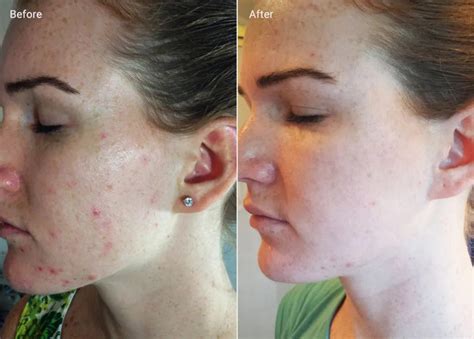 Microdermabrasion Blackheads Before And After