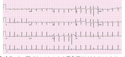 Figure 2 from Junctional ectopic tachycardia secondary to myocarditis associated with sudden ...