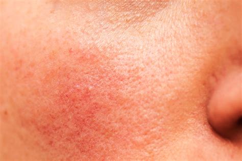 Skin Disease: Signs of Disease Your Skin Can Reveal | Best Health