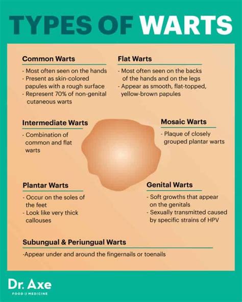 How to Get Rid of Warts Naturally without Surgery! | Types of warts, Get rid of warts, Warts