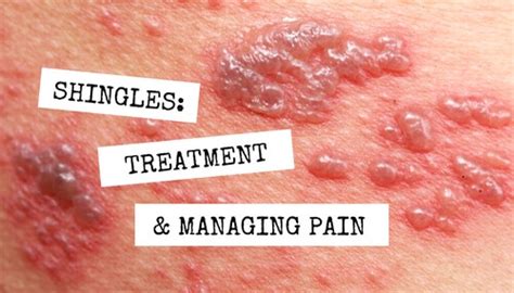 Shingles: Treatment and Managing Pain - WCEI Blog WCEI Blog