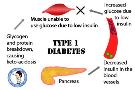 Type 1 Diabetes Causes, Signs & Symptoms, Effects, Prevention ...