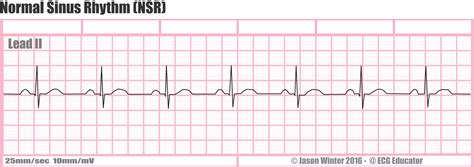 ECG Educator Blog : Six Second ECG Rhythm Strips