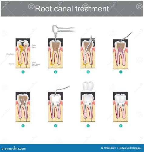 Root Canal Treatment Linear Icon Set. Stages Of Tooth Cleaning And Filling With Filles, Gutta ...