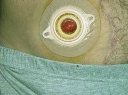 Colostomy Stoma: Colostomy Stoma Pictures