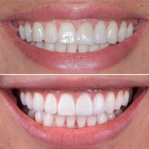 Emax Veneers in Turkey can be completed in 5 days