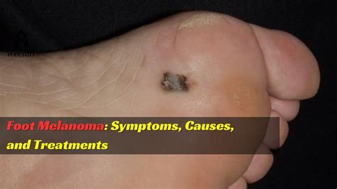 Foot Melanoma: Symptoms, Causes, And Treatments